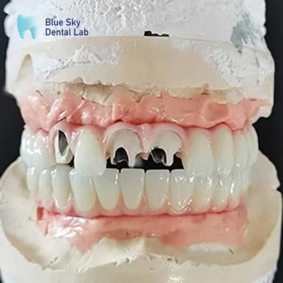 ซื้อ ทิตาเนียม Malo Bridge สะพานการปลูกโดยไม่มีหลายหน่วย Abutment online manufacture