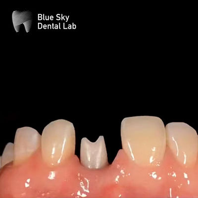 ซื้อ อุปกรณ์ปลูกฟันแบบ Hypoallergenic Zirconia Abutment สะสมกับชีวภาพ online manufacture