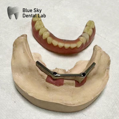 ซื้อ อุปกรณ์ฝังฟัน Overdenture ทิตาเนียมบาร์ อุปกรณ์ฝังฟันที่มีฟันเทียมถอดได้ online manufacture