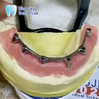 ซื้อ อุปกรณ์เสริมเสริมที่ถอดได้ด้วยอาการเสริมทิตาเนียม online manufacture