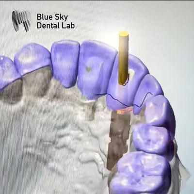 ซื้อ แซนด์บลาสต์ ASC Abutment ทิตาเนียมบริสุทธิ์มุมสกรูช่อง Abutment online manufacture