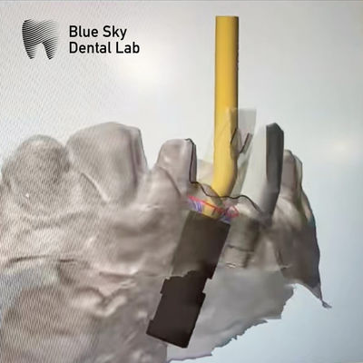 ซื้อ Ti Base Screw Retained Abutment Implant มุมสกรูช่องสกรู online manufacture