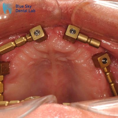 ทอง ทิตาเนียม Multi Unit Scan Body ระบบ CAM Dentium Scan Body