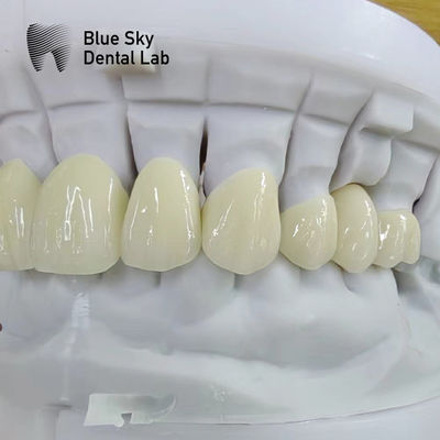 สายมงคลซิกโอนีซชั้นใส การฟื้นฟูฟันหลายชั้น สายมงคลซิกโอนีซชั้น