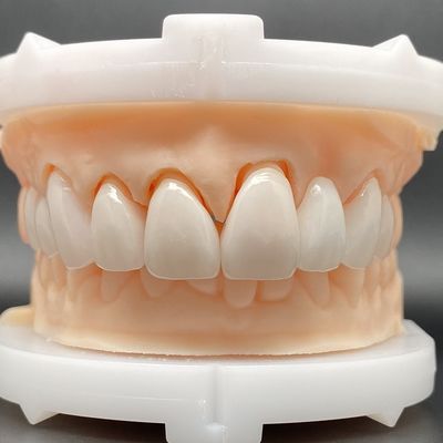 EMax Veneer Cases Passive Fitting ในหลายสี ทําให้รอยยิ้มสวยงาม ด้วยการเตรียมฟันอย่างน้อย