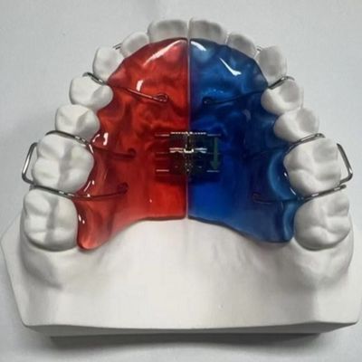 สแตนเลส สกรูอะคริลิค ขยายการรักษา Orthodontic ถอนได้